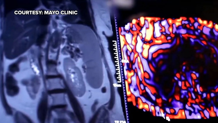 Healthy SA: Battling liver cancer, a disease which often has no symptoms early on — KENS 5 (San Antonio), Williston Health news